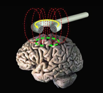 What You Need to Know About Transcranial Magnetic Stimulation for OCD
