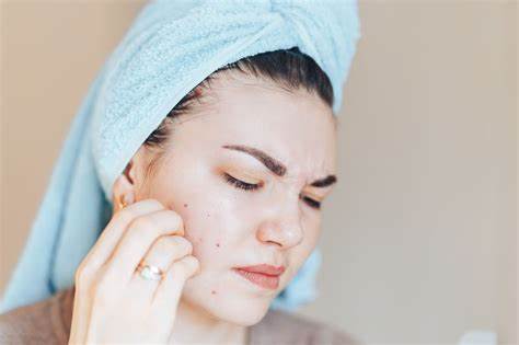 ocd skin picking treatment