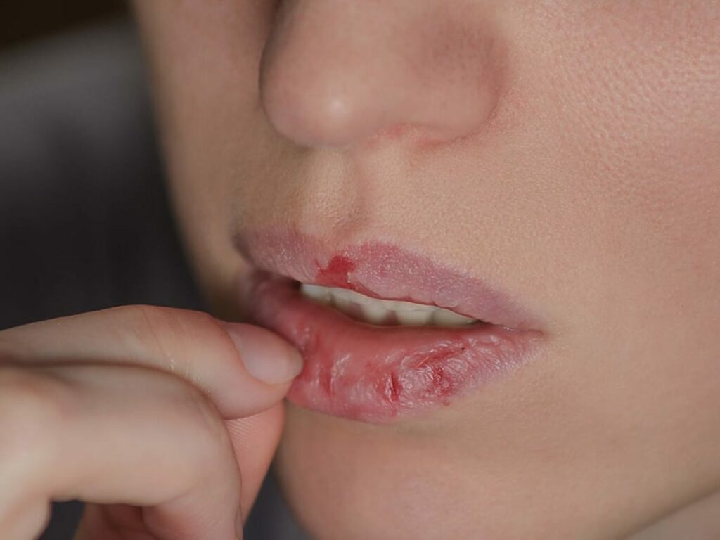 dermatillomania ocd